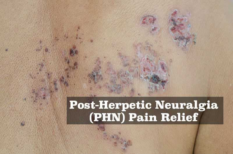 Post-Herpetic Neuralgia (PHN) Pain Relief